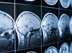 Brain Injuries